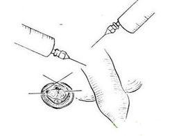 割包皮手术视频全过程,专业视角下的手术过程解析