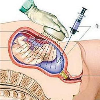 羊水穿刺过程视频,技术操作与注意事项