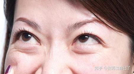 内路祛眼袋视频,揭秘无痕除眼袋的秘密